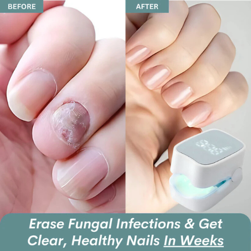 trivora™ - Nail Fungus Laser Device
